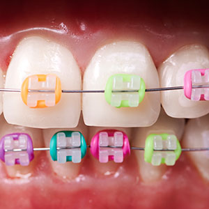 The image shows a close-up view of a set of teeth with multiple colored braces, featuring silver, pink, green, blue, and white elastics.
